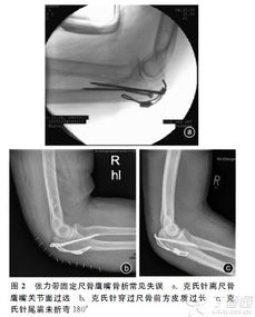 尺骨鹰嘴骨折手术技巧