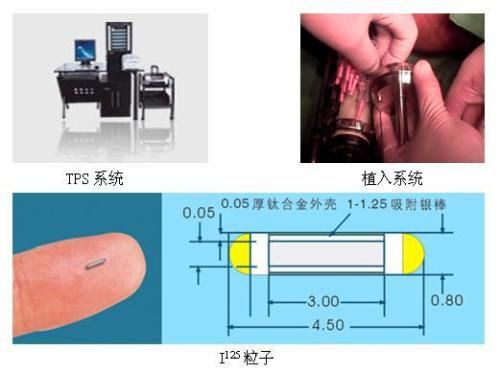 碘125粒子可以用医保报销吗