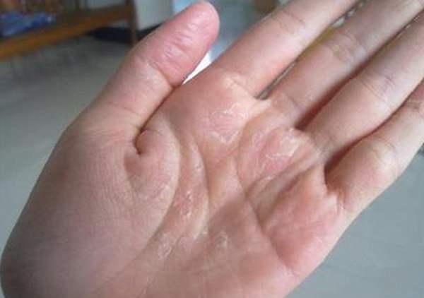 手指上经常长出 小疙瘩 ,不但痒,还会 脱皮 ,是怎么回事
