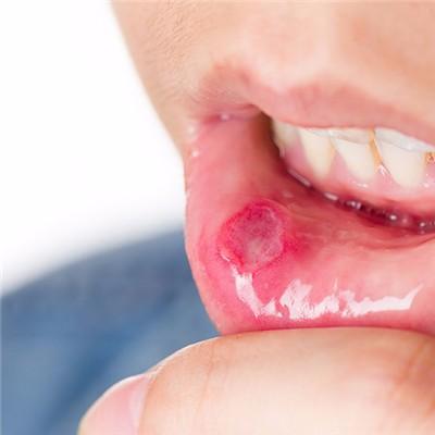 嘴唇内部溃疡是什么原因