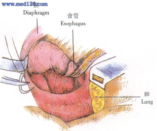 食管裂孔疝修补术操作步骤,图片图谱图解,手术治疗方法,诊断食管手术 