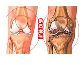 骨质增生导致腿变形怎么办 