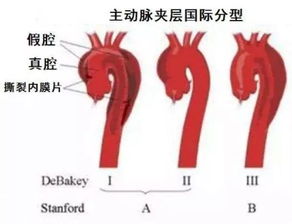 主动脉夹层3型要手术吗做多少钱术后寿命