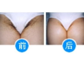 女性比基尼部位脱毛图片 少儿不宜