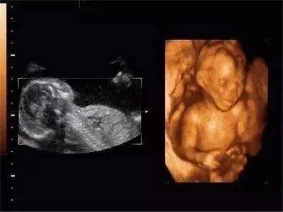 怀孕八个月胎儿彩超 怀孕八个月了要检查什么才能看出来胎儿有没有畸形