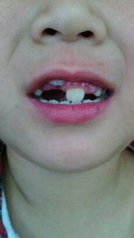 小孩七岁半,经x光检查上门牙有两颗多生牙未萌出,导致已长出的门牙错位 需拔除多生牙吗 如不拔除等牙 