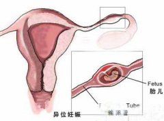 宫外孕如何流产(宫外孕该怎么流产)