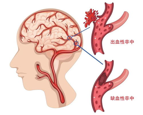 预防脑梗复发,四种方法让你远离脑梗