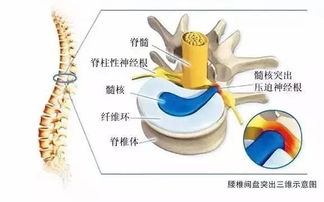 闪了下腰后竟卧床不起 238斤胖小伙遭遇 腰突