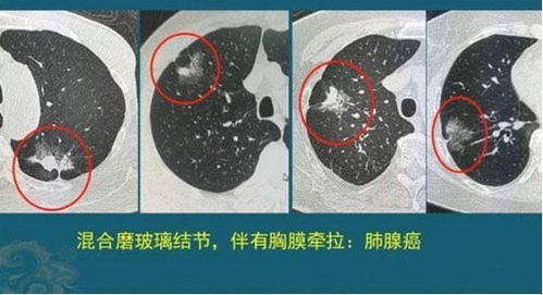 体检查出肺结节,担心是恶性 医生 若没有3种情况,且放宽心