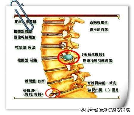 脊椎骨质增生症