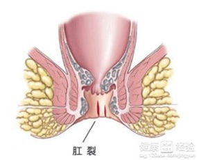 肛裂自治法