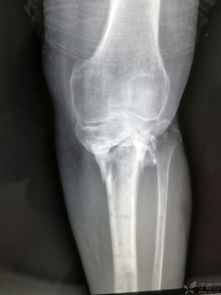 左小腿胫腓骨骨折图片 搜狗图片搜索