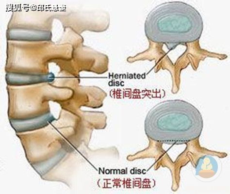 腰椎间盘突出压迫神经腿疼怎么治 邱氏悬壶