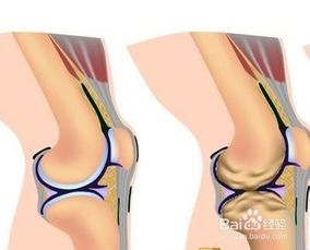 膝盖突然疼是怎么回事 