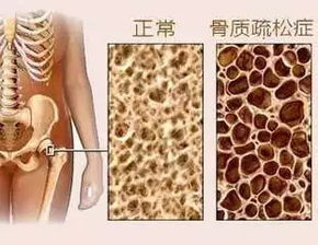 医生,我要不要做个骨密度测定