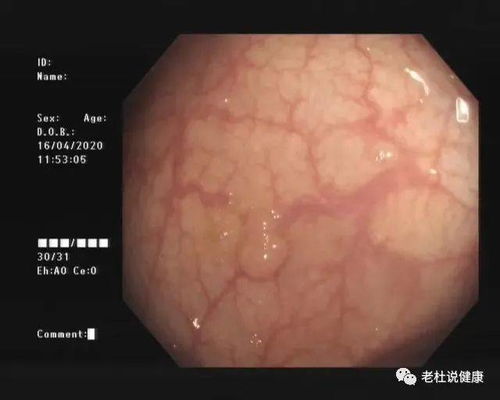 5毫米的肠息肉,20年不切不查,终成进展期肠癌