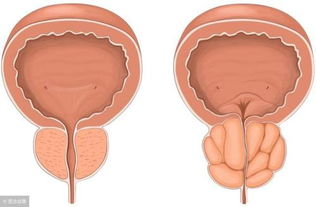 前列腺增生吃什么好(前列腺增生吃什么药效果最好)