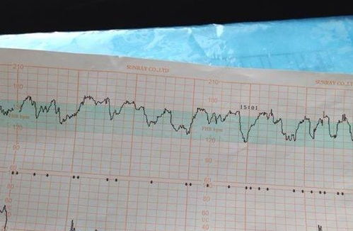 看不懂胎心监护图 二胎宝妈 记住2个关键数据,就明白了