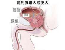 前列腺肥大的病因 治疗 症状检查 诊断 预防 医院 求医网 