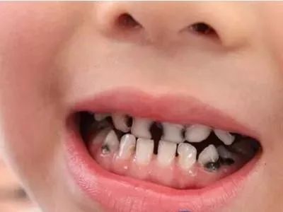 孩子蛀牙，晚上痛的厉害要怎么处理呢(儿童晚上蛀牙疼快速止疼法)