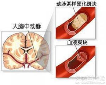 引起脑梗塞的原因是什么