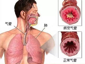 得了咳嗽 支气管炎怎么治疗 一定收好了