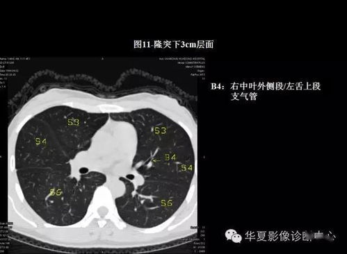 肺部感染 CT 太难学 看完这篇干货不信你还不会