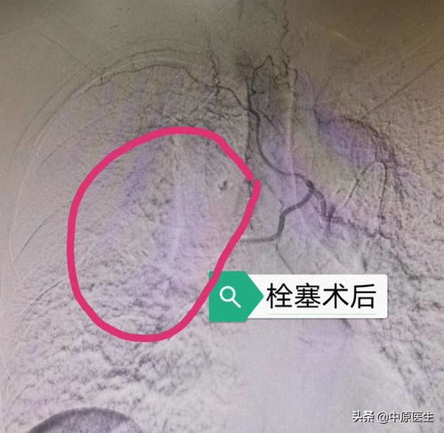 50岁的癌症患者，可以不化疗不手术吗(50岁得癌症能活多久)