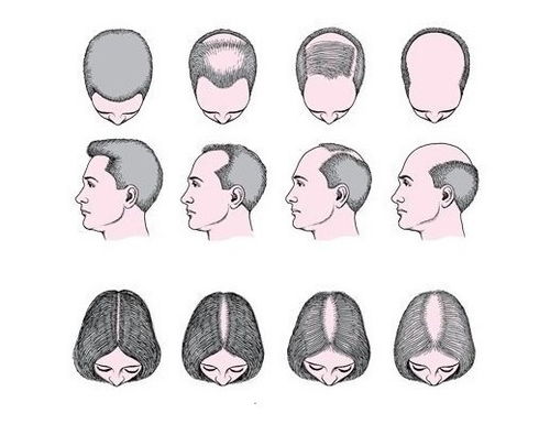 秃顶的原因 秃头是什么原因导致的