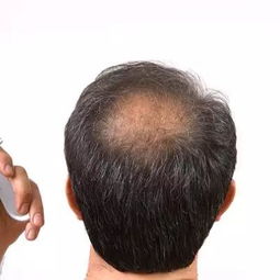 脱发的表现男女各不同,这些治疗方法你必须知道