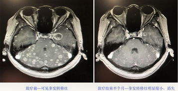 放疗在肺癌脑转移治疗中的价值 经典病例