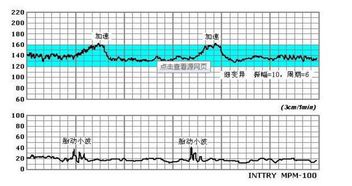 胎心监护加速减速是什么 为什么胎心监护曲线会平缓