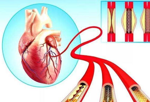 做心脏支架到底好不好 放了支架后还能活多久 看完你就明白了