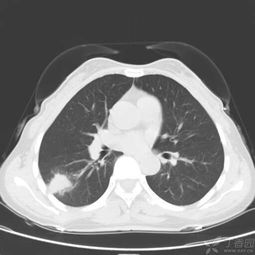 求助肺部CT片定性