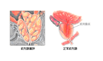 前列腺囊肿能过性生活吗-图2