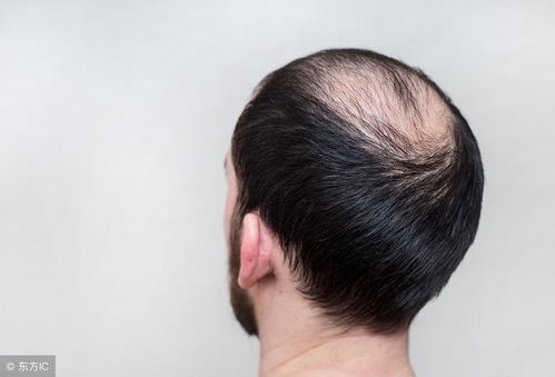 人到中年容易秃 有没有什么方法能防止脱发 