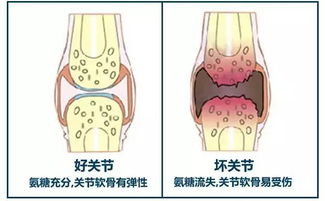 腿膝盖后面疼是怎么回事