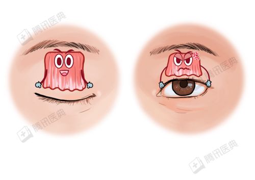 眼睛肌肉抖动应该如何治疗？