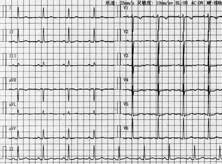 T波低平的诊断 病因 机制与意义 早看这篇早会了 