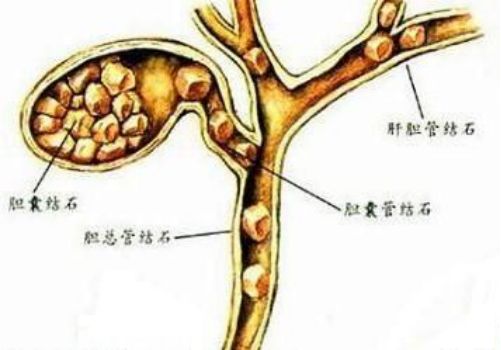 走进医学 让你了解胆总管结石的治疗方式 患者 