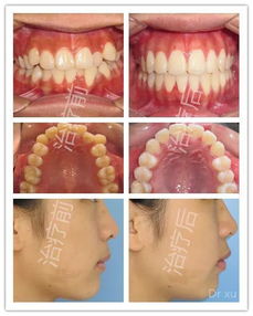 矫正牙齿一定要拔牙吗 如果是属于这三种情况还真是要拔..... 