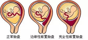 孕期胎盘低 你知道该如何 涨上去 吗