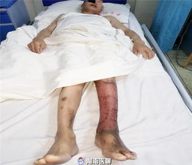 男子取 土药 治腿伤,下肢溃烂一拖20年 做梦都想有条 好 腿
