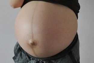 看妊娠纹判断生男生女超准 生儿子的妊娠线图片 3