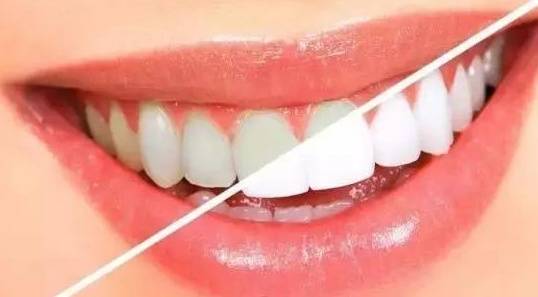 福清口腔医院 优贝口腔告诉你这六大牙齿美白误区,大家别再犯了