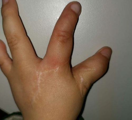 手指尖植皮恢复期间应注意哪些…做完值皮手术后在饮食方面应注意些