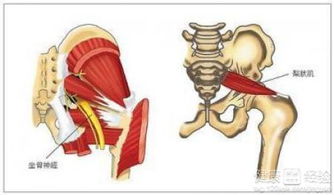 如何预防髂腹股沟神经干痛