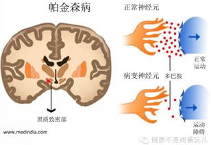 多巴胺假说 搜狗百科 