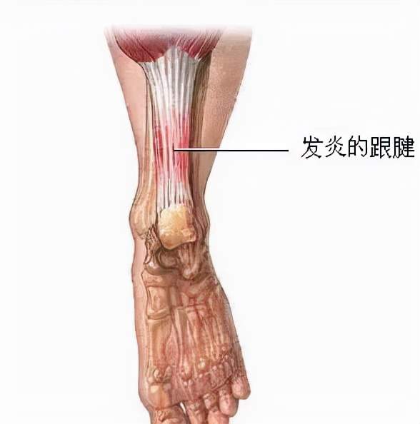 运动完脚后跟疼 跟腱炎该如何防治